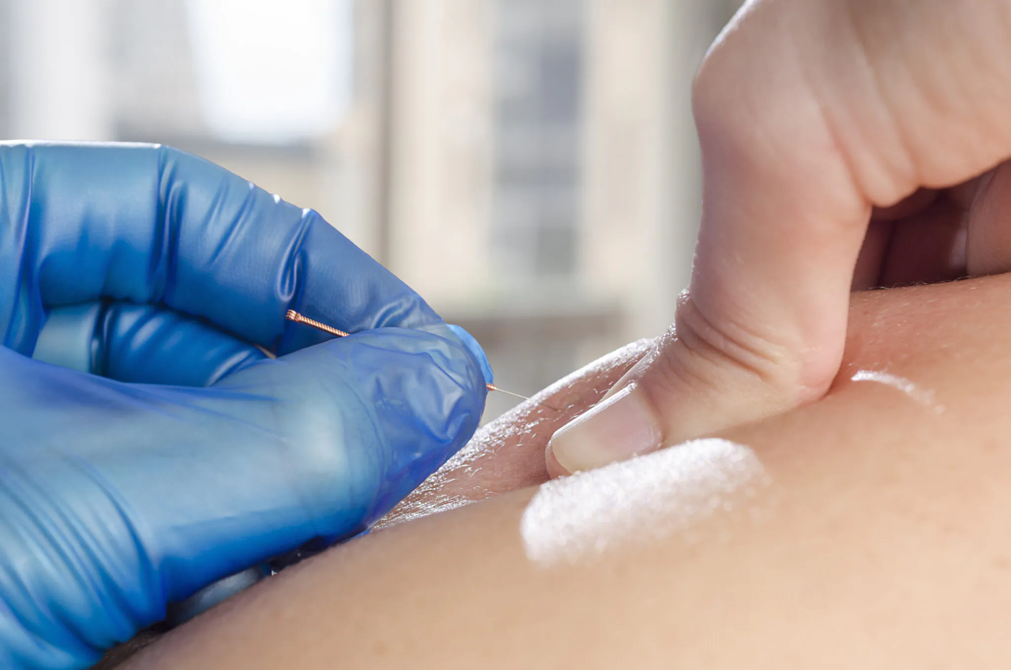 Needle and hands of physiotherapist doing a dry needling